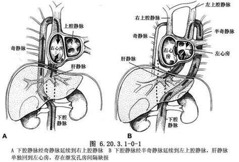 下腔靜脈 孕婦